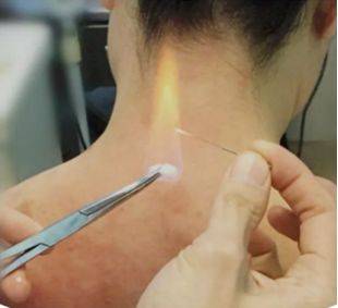 火針可以治療痤瘡嗎？